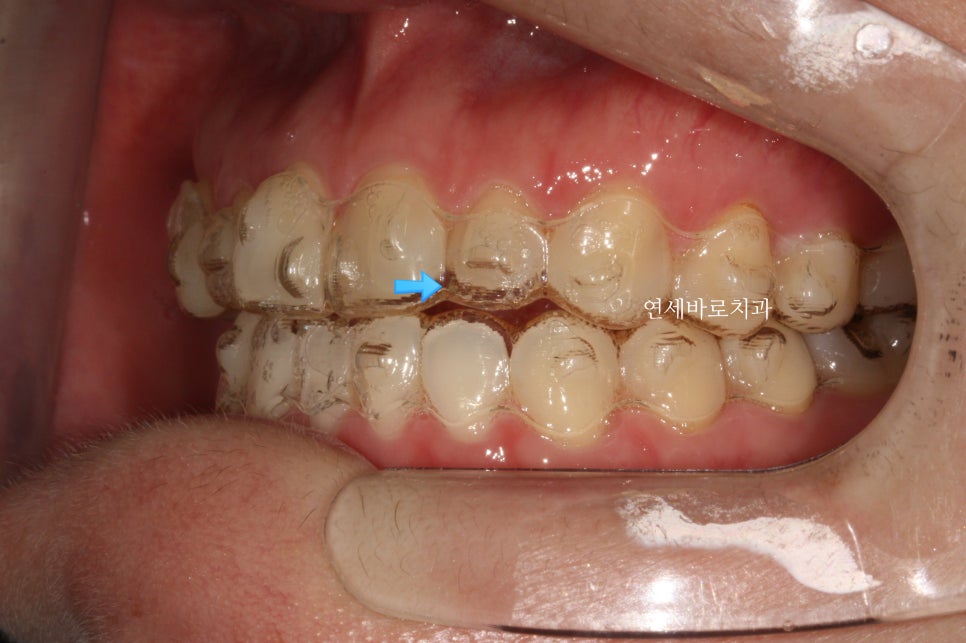 무삭제라미네이트 젤라미, 그리고 인비절라인 라이트 조합