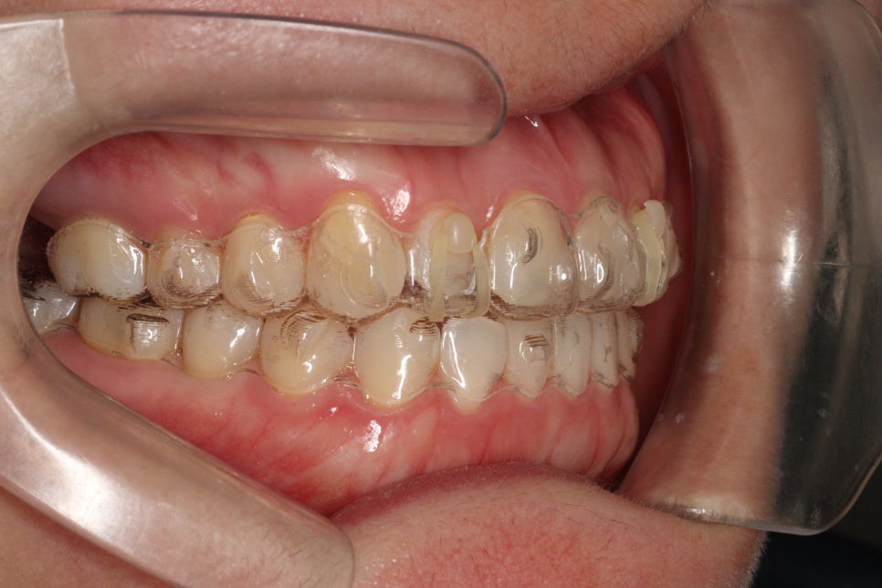 무삭제라미네이트 젤라미, 그리고 인비절라인 라이트 조합