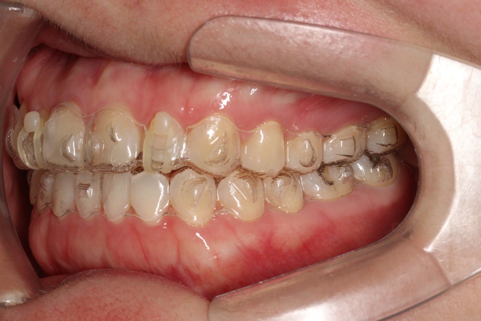 무삭제라미네이트 젤라미, 그리고 인비절라인 라이트 조합