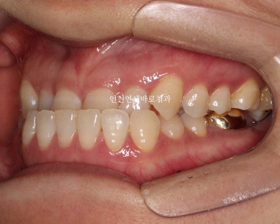 비수술 주걱턱 교정, 비발치 철사교정 치료 후기