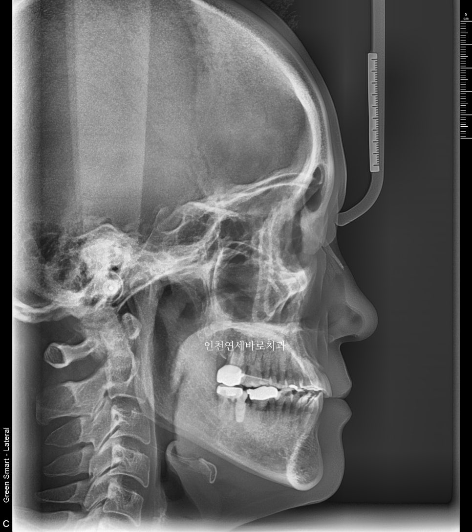 비수술 주걱턱 교정, 비발치 철사교정 치료 후기