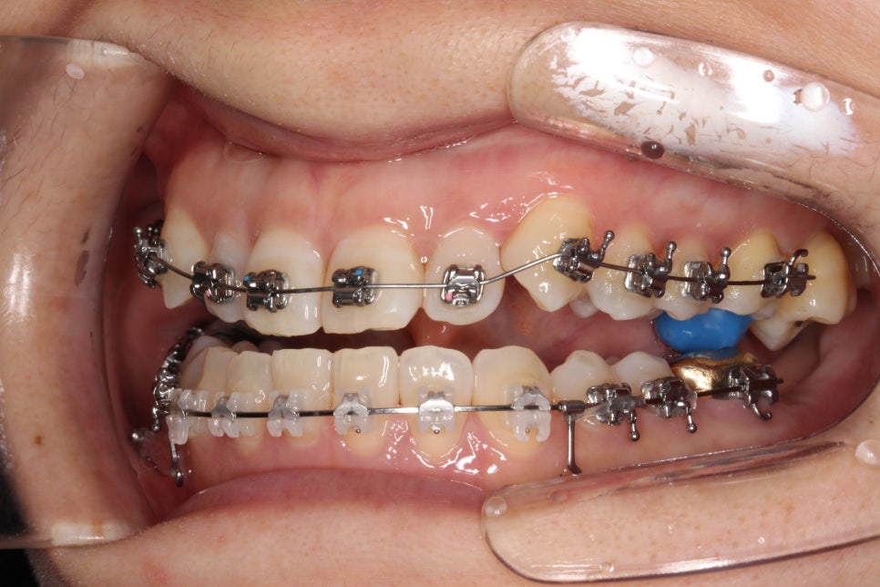 비수술 주걱턱 교정, 비발치 철사교정 치료 후기