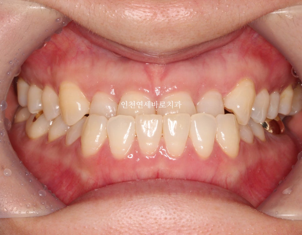 비수술 주걱턱 교정, 비발치 철사교정 치료 후기