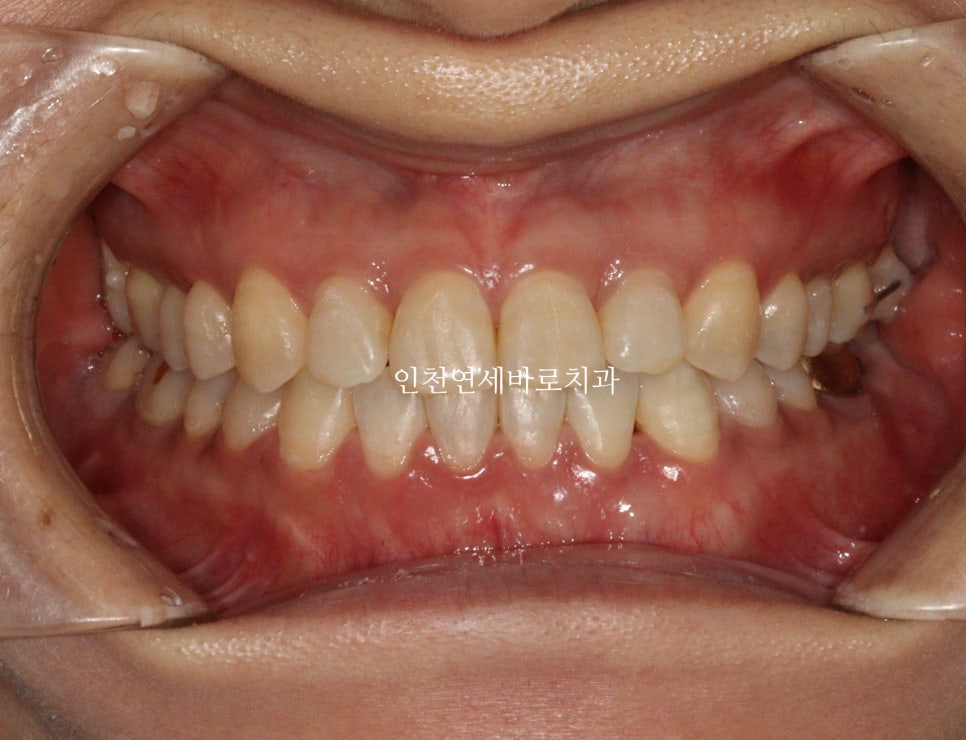 비수술 주걱턱 교정, 비발치 철사교정 치료 후기