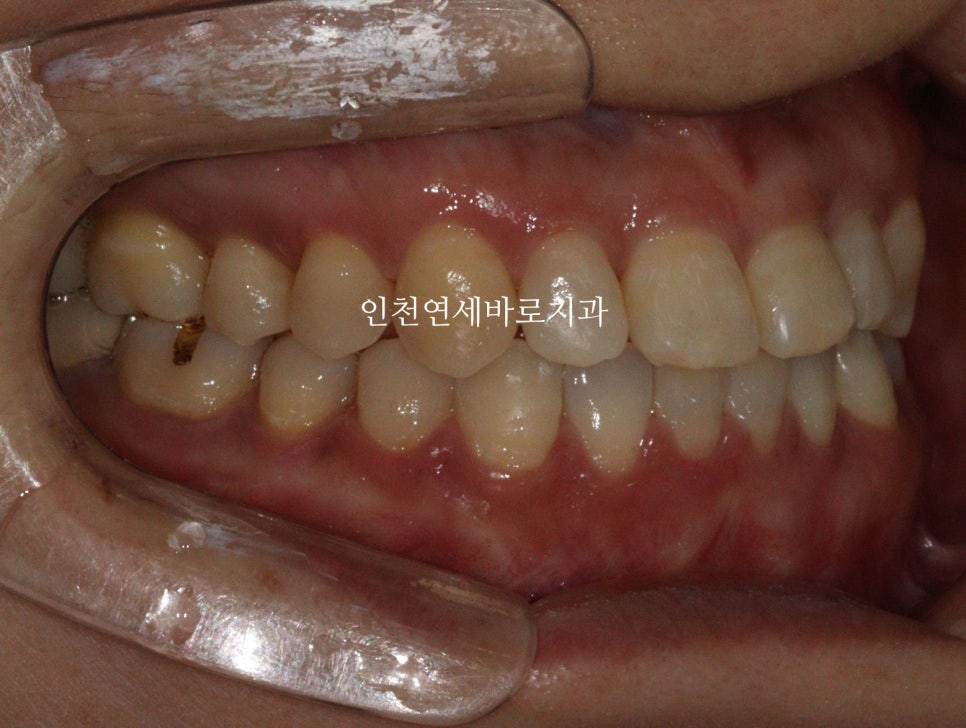 비수술 주걱턱 교정, 비발치 철사교정 치료 후기