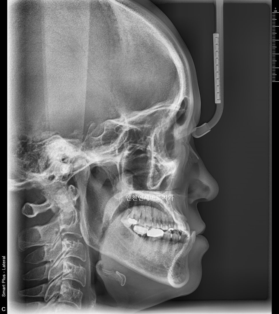 비수술 주걱턱 교정, 비발치 철사교정 치료 후기