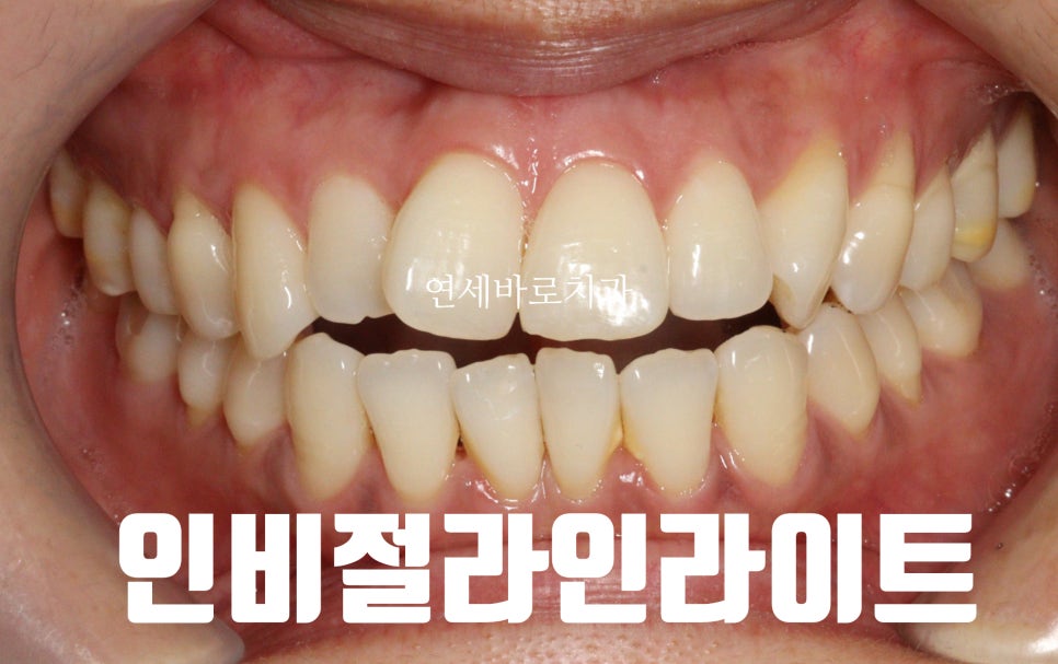 투명교정 인비절라인 라이트 오픈바이트 치료 후기