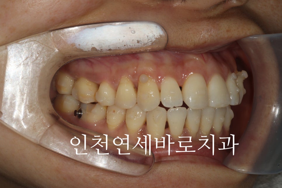 투명교정 인비절라인 라이트 오픈바이트 치료 후기