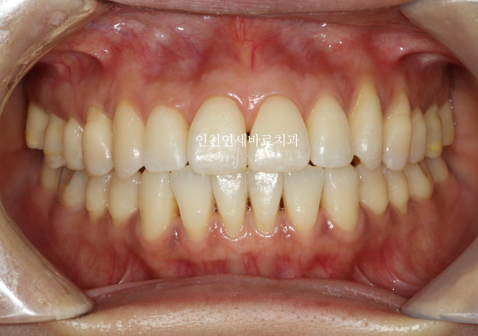 투명교정 인비절라인 라이트 오픈바이트 치료 후기