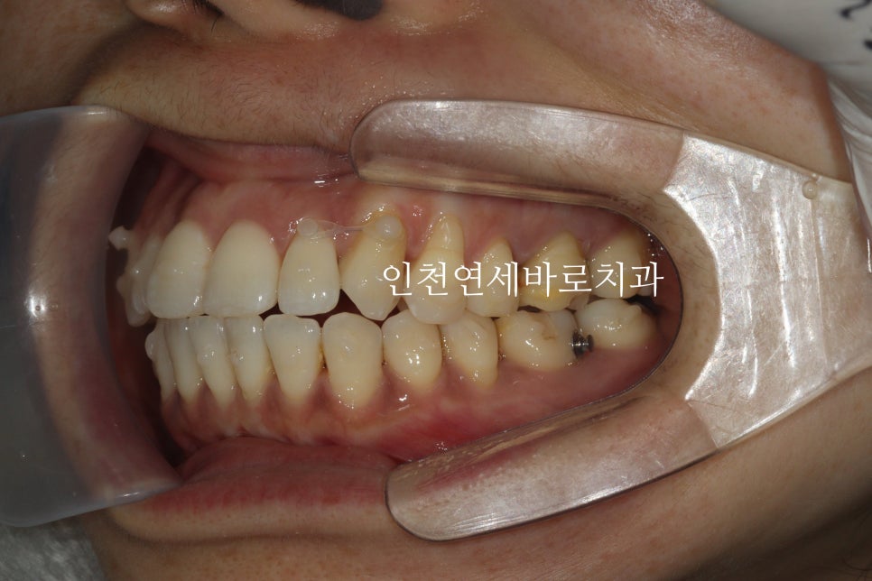투명교정 인비절라인 라이트 오픈바이트 치료 후기