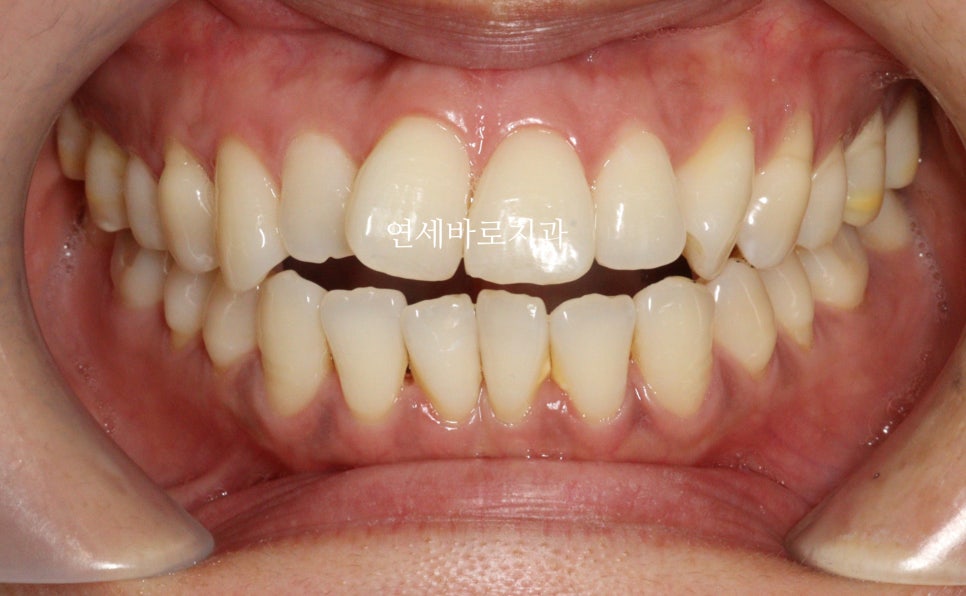 투명교정 인비절라인 라이트 오픈바이트 치료 후기