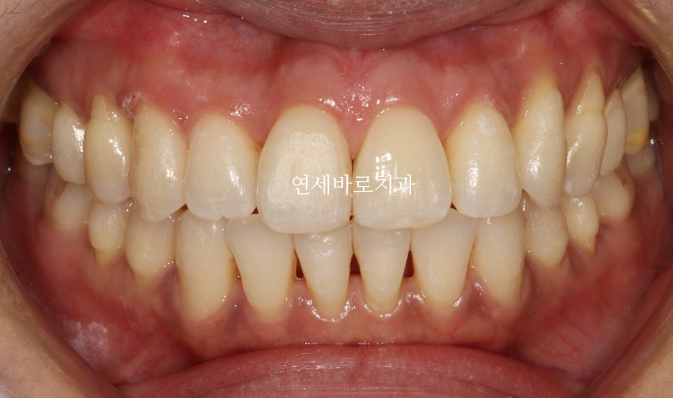 투명교정 인비절라인 라이트 오픈바이트 치료 후기