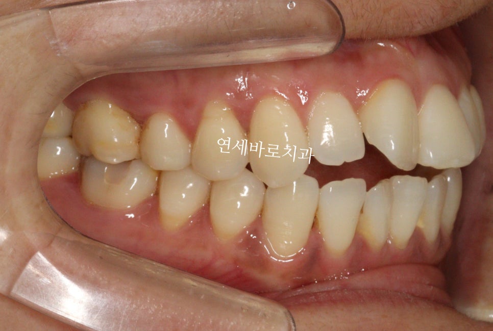 투명교정 인비절라인 라이트 오픈바이트 치료 후기