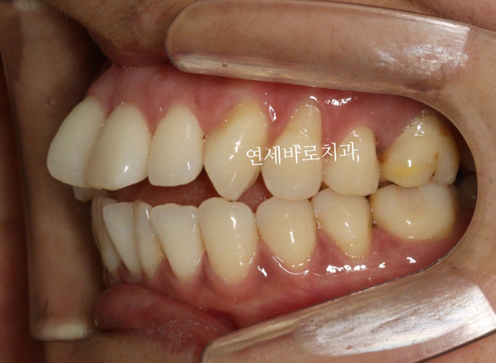 투명교정 인비절라인 라이트 오픈바이트 치료 후기