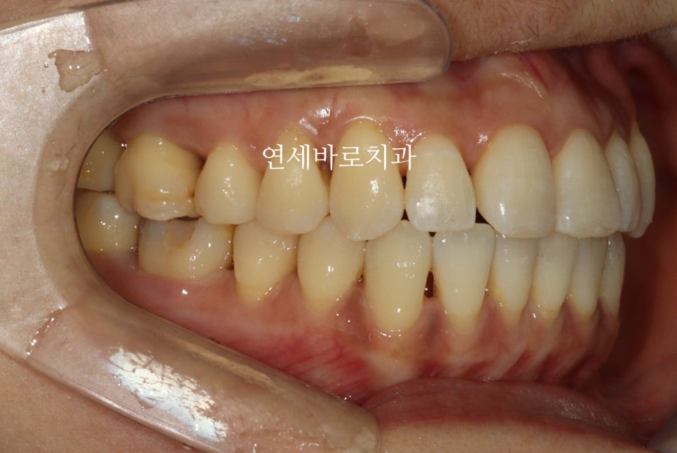투명교정 인비절라인 라이트 오픈바이트 치료 후기
