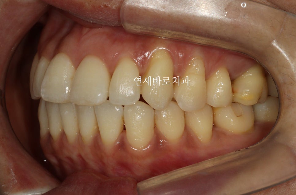 투명교정 인비절라인 라이트 오픈바이트 치료 후기