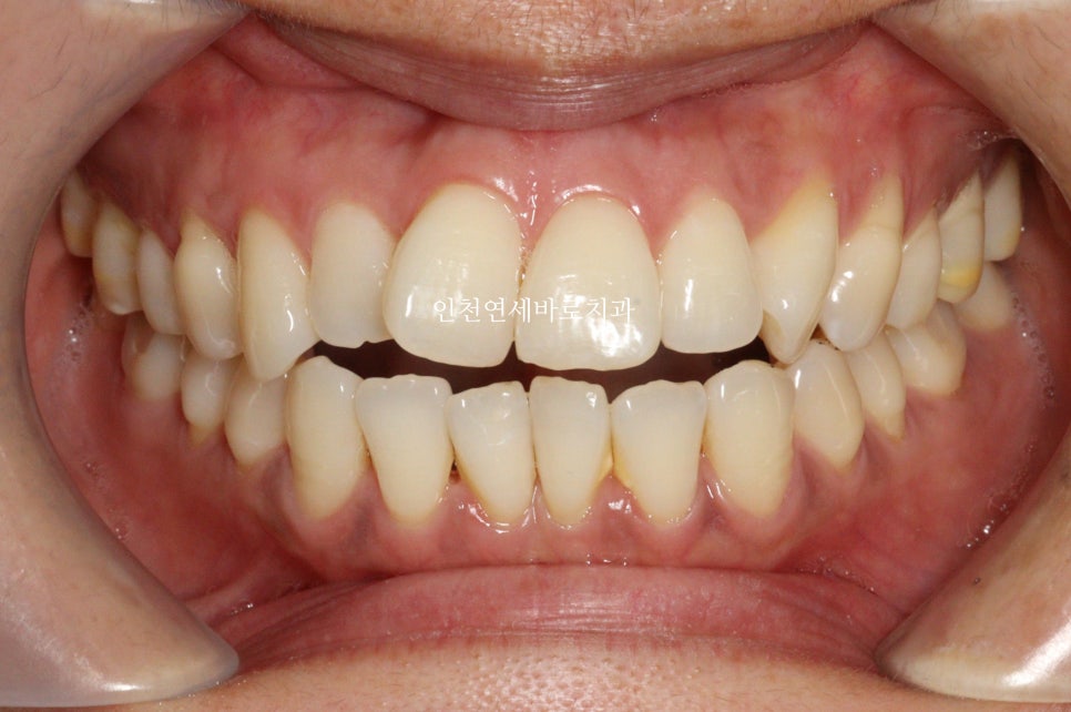 투명교정 인비절라인 라이트 오픈바이트 치료 후기