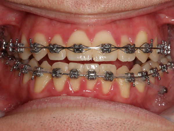 저 철사교정도 많이 해요. 인비절라인만 하는 치과의사 아닙니다.