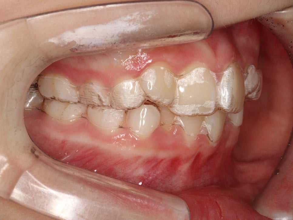 저 철사교정도 많이 해요. 인비절라인만 하는 치과의사 아닙니다.