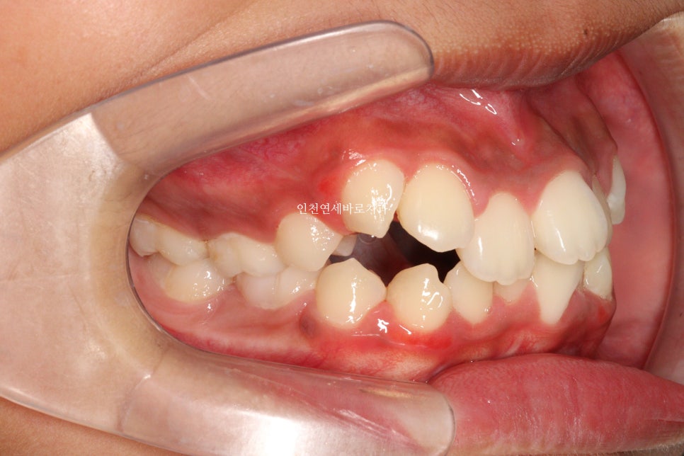 인비절라인 퍼스트로 치료가 안되요