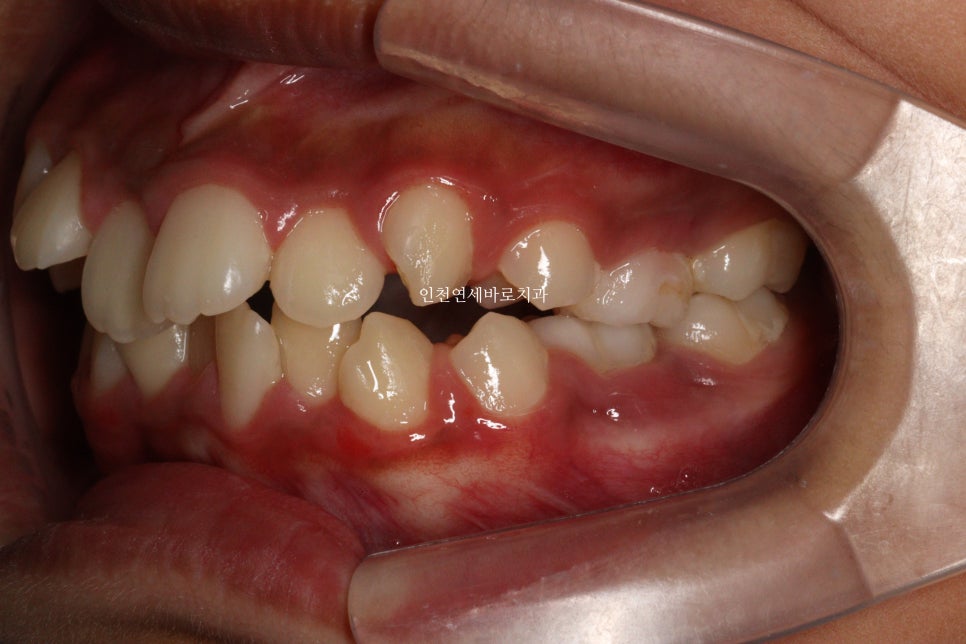 인비절라인 퍼스트로 치료가 안되요