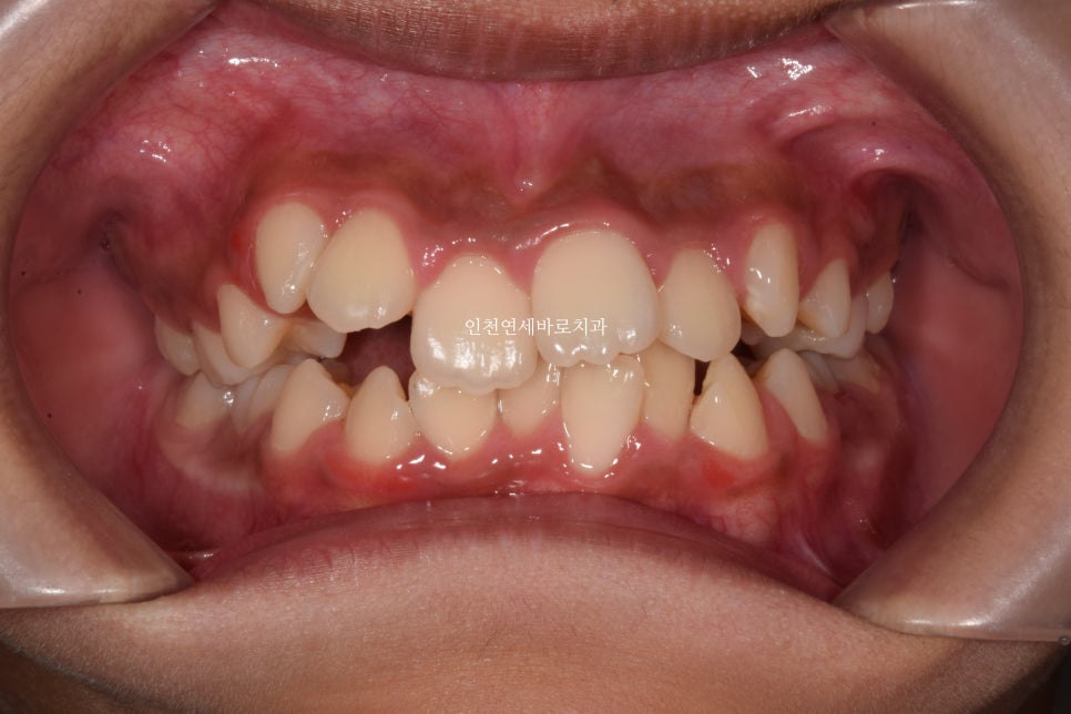 인비절라인 퍼스트로 치료가 안되요