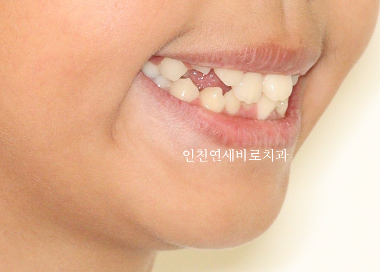 인비절라인 퍼스트로 치료가 안되요