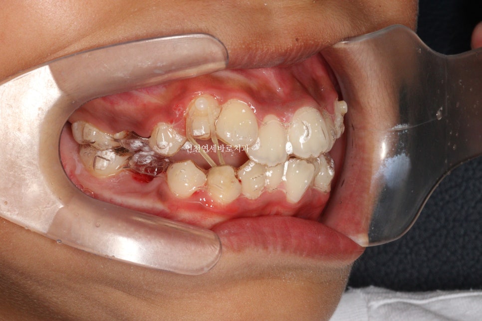 인비절라인 퍼스트로 치료가 안되요