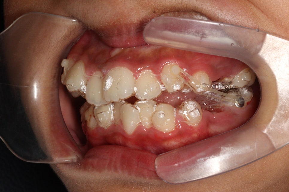 인비절라인 퍼스트로 치료가 안되요