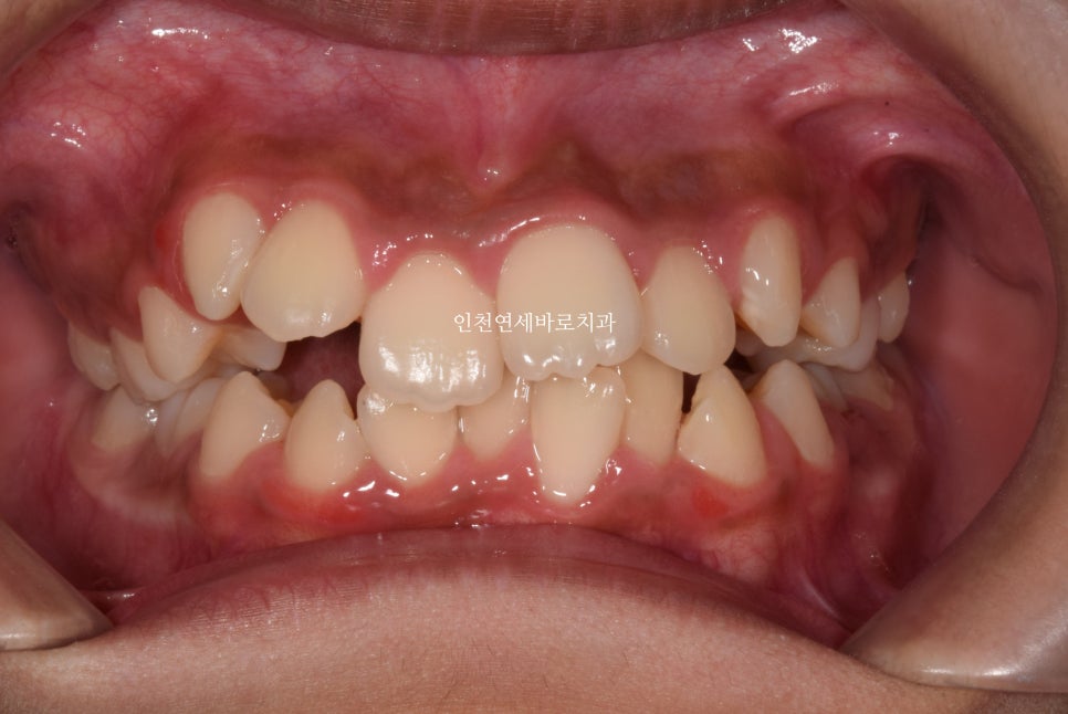 인비절라인 퍼스트로 치료가 안되요