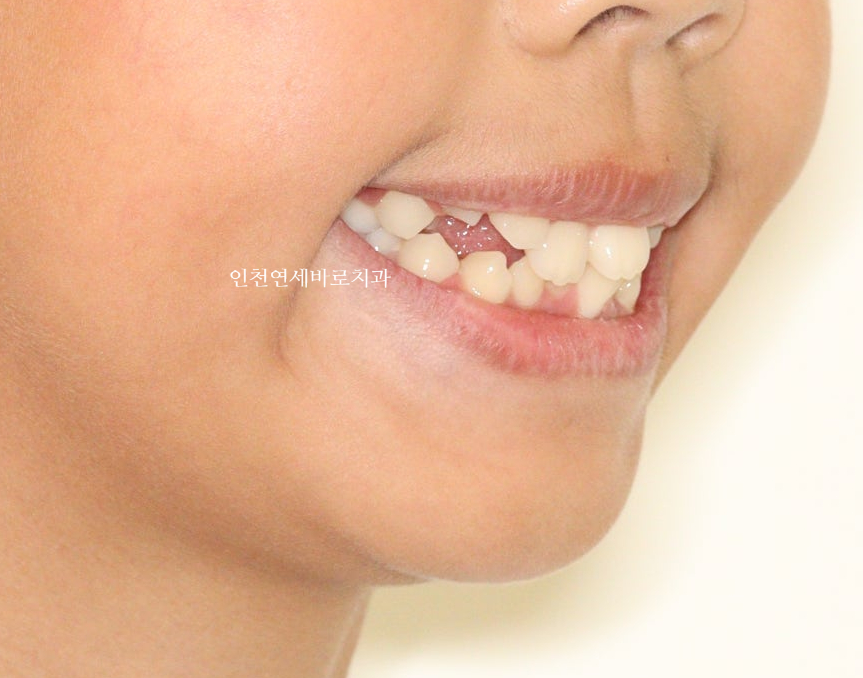 인비절라인 퍼스트로 치료가 안되요