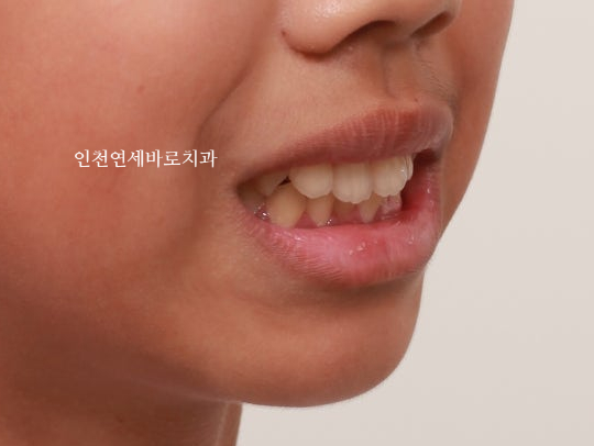 인비절라인 퍼스트로 치료가 안되요