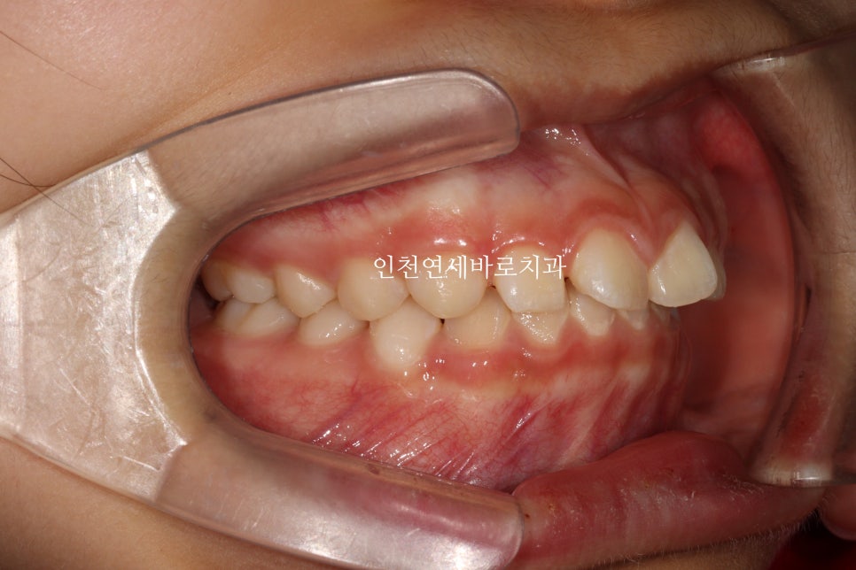 치아교정 인비절라인 라이트 14주만에 치아배열 완료