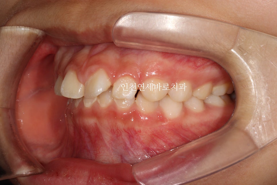 치아교정 인비절라인 라이트 14주만에 치아배열 완료