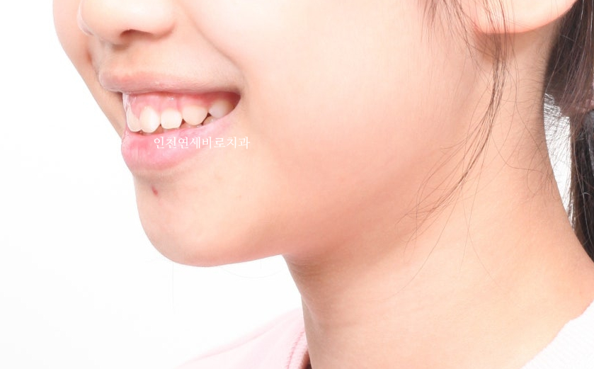 치아교정 인비절라인 라이트 14주만에 치아배열 완료