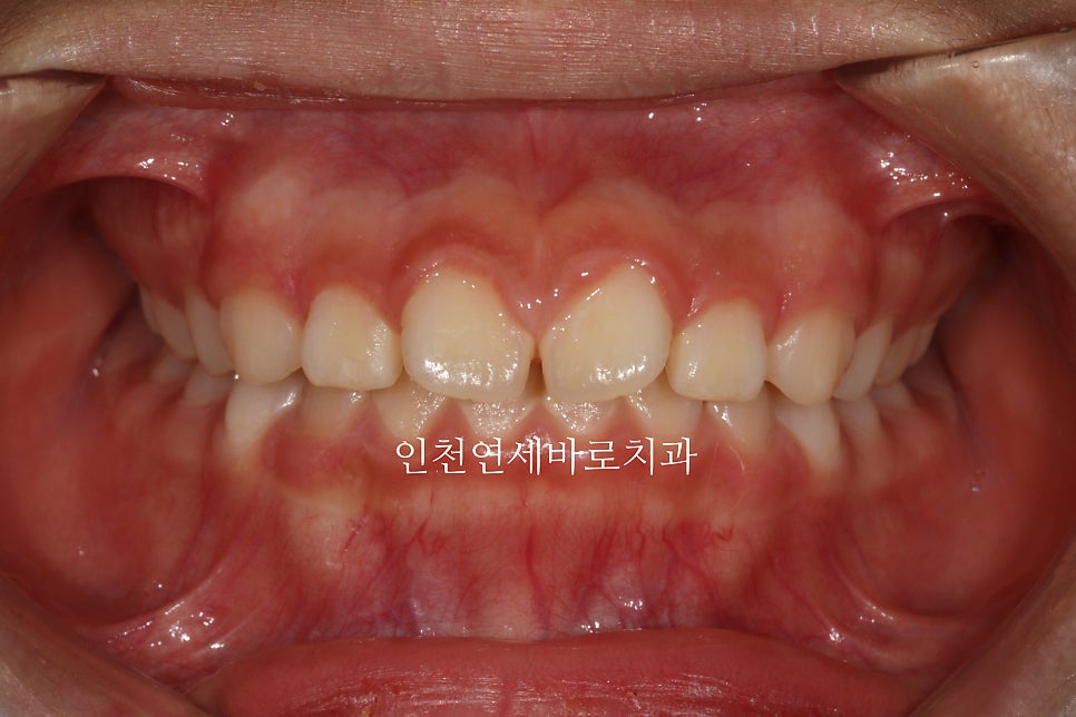 치아교정 인비절라인 라이트 14주만에 치아배열 완료