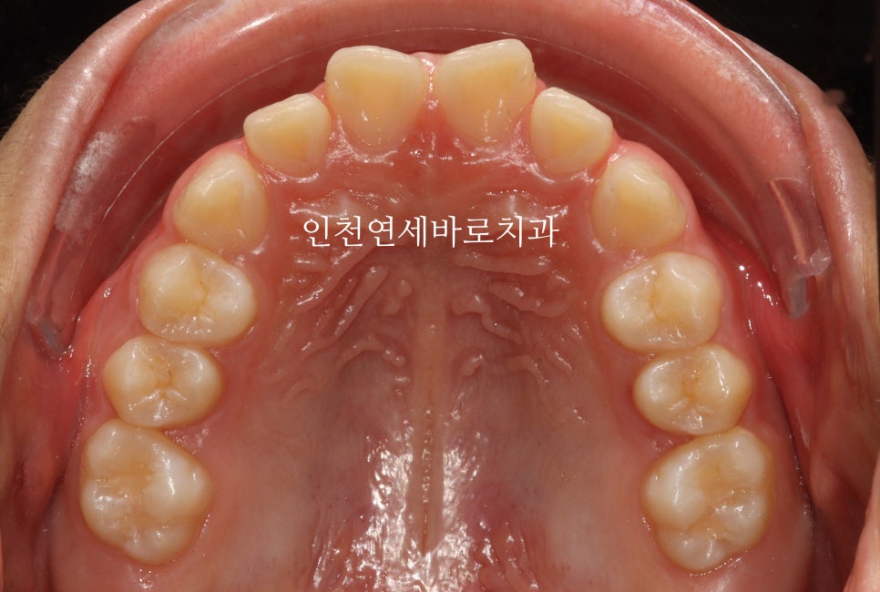 치아교정 인비절라인 라이트 14주만에 치아배열 완료
