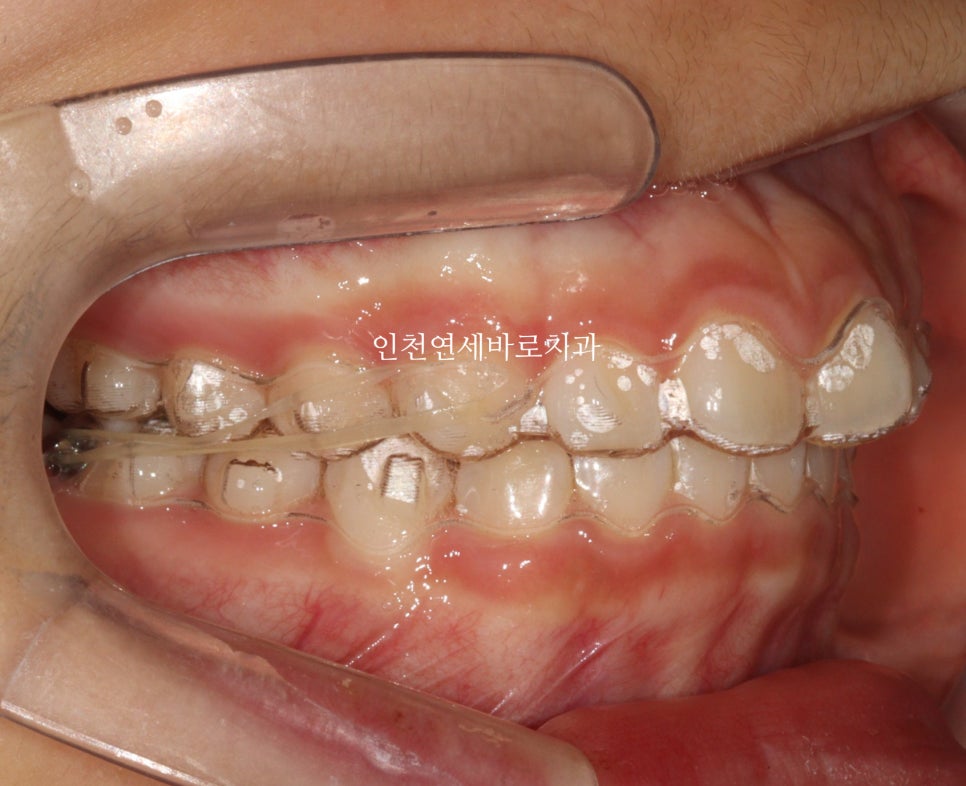 치아교정 인비절라인 라이트 14주만에 치아배열 완료