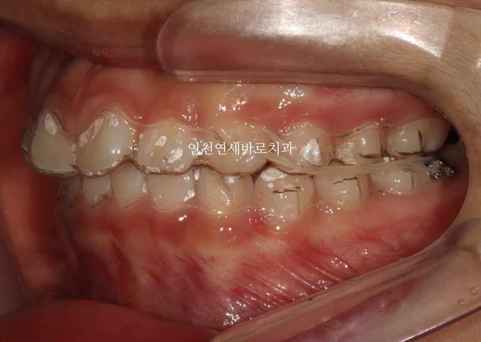 치아교정 인비절라인 라이트 14주만에 치아배열 완료