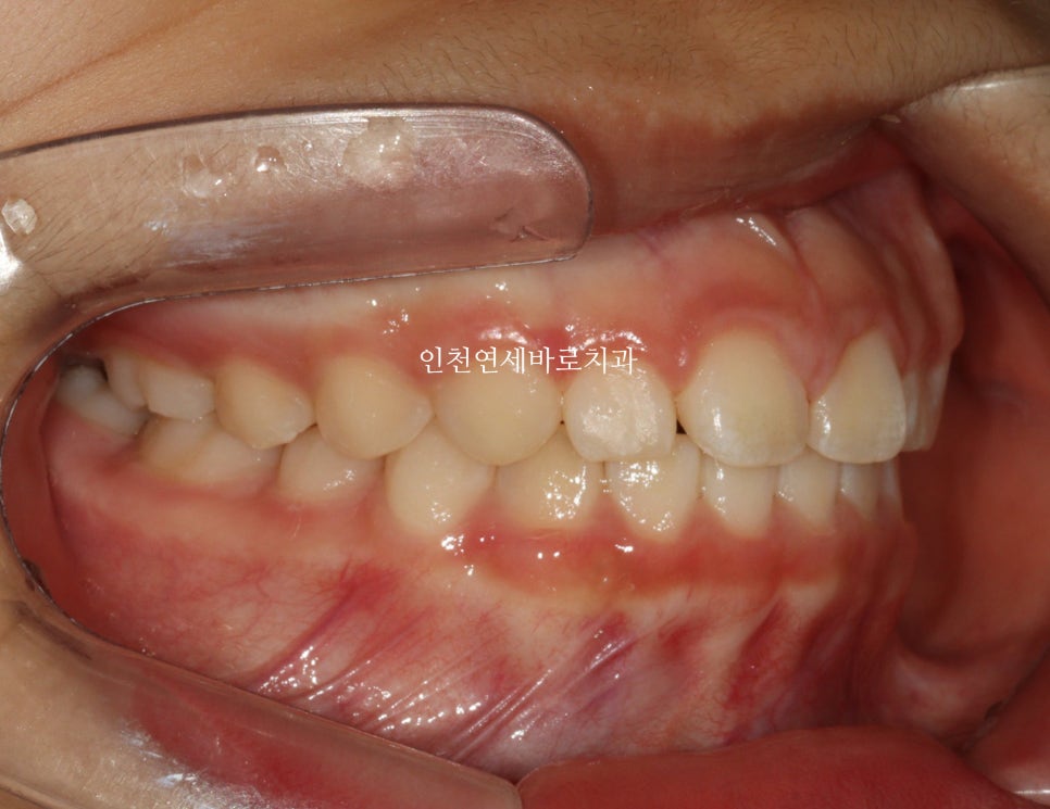 치아교정 인비절라인 라이트 14주만에 치아배열 완료