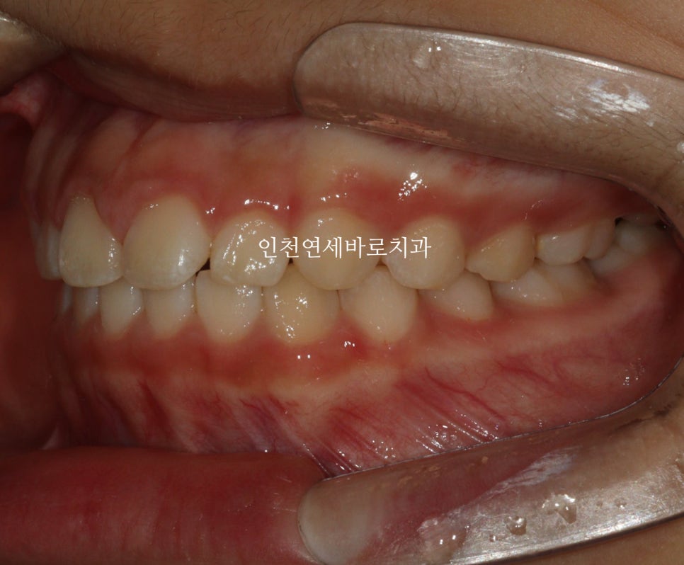 치아교정 인비절라인 라이트 14주만에 치아배열 완료
