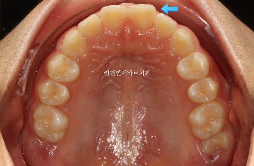 치아교정 인비절라인 라이트 14주만에 치아배열 완료