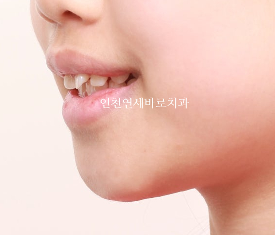 치아교정 인비절라인 라이트 14주만에 치아배열 완료