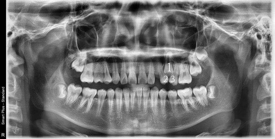 인비절라인 치료 치아 위치 이상 23년 11월~ 24년 10월 기록