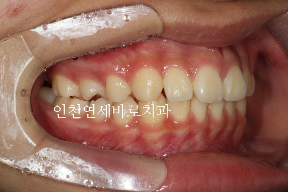인비절라인 치료 치아 위치 이상 23년 11월~ 24년 10월 기록