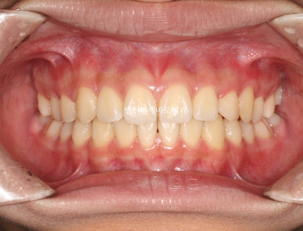 인비절라인 치료 치아 위치 이상 23년 11월~ 24년 10월 기록