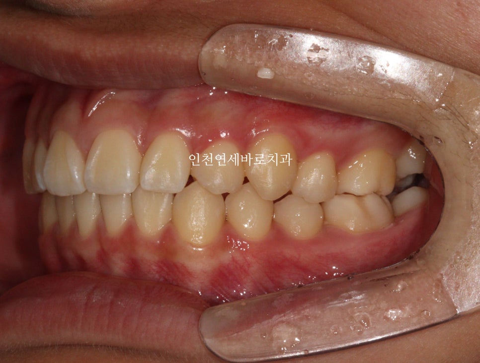 인비절라인 치료 치아 위치 이상 23년 11월~ 24년 10월 기록