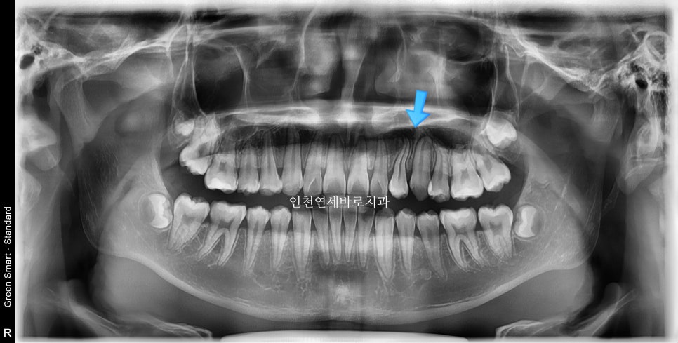 인비절라인 치료 치아 위치 이상 23년 11월~ 24년 10월 기록