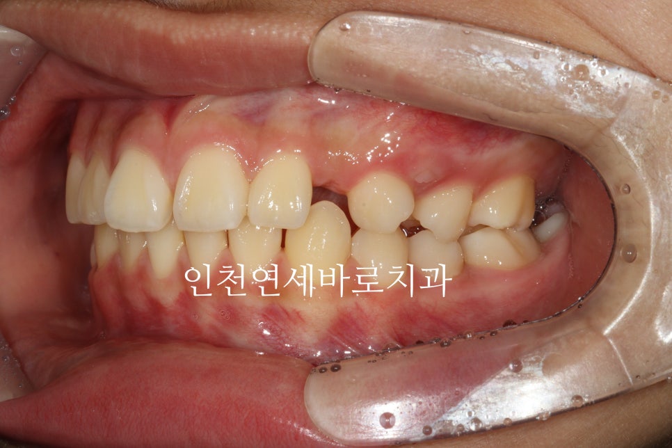 인비절라인 치료 치아 위치 이상 23년 11월~ 24년 10월 기록
