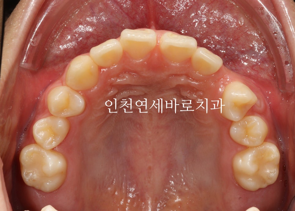 인비절라인 치료 치아 위치 이상 23년 11월~ 24년 10월 기록